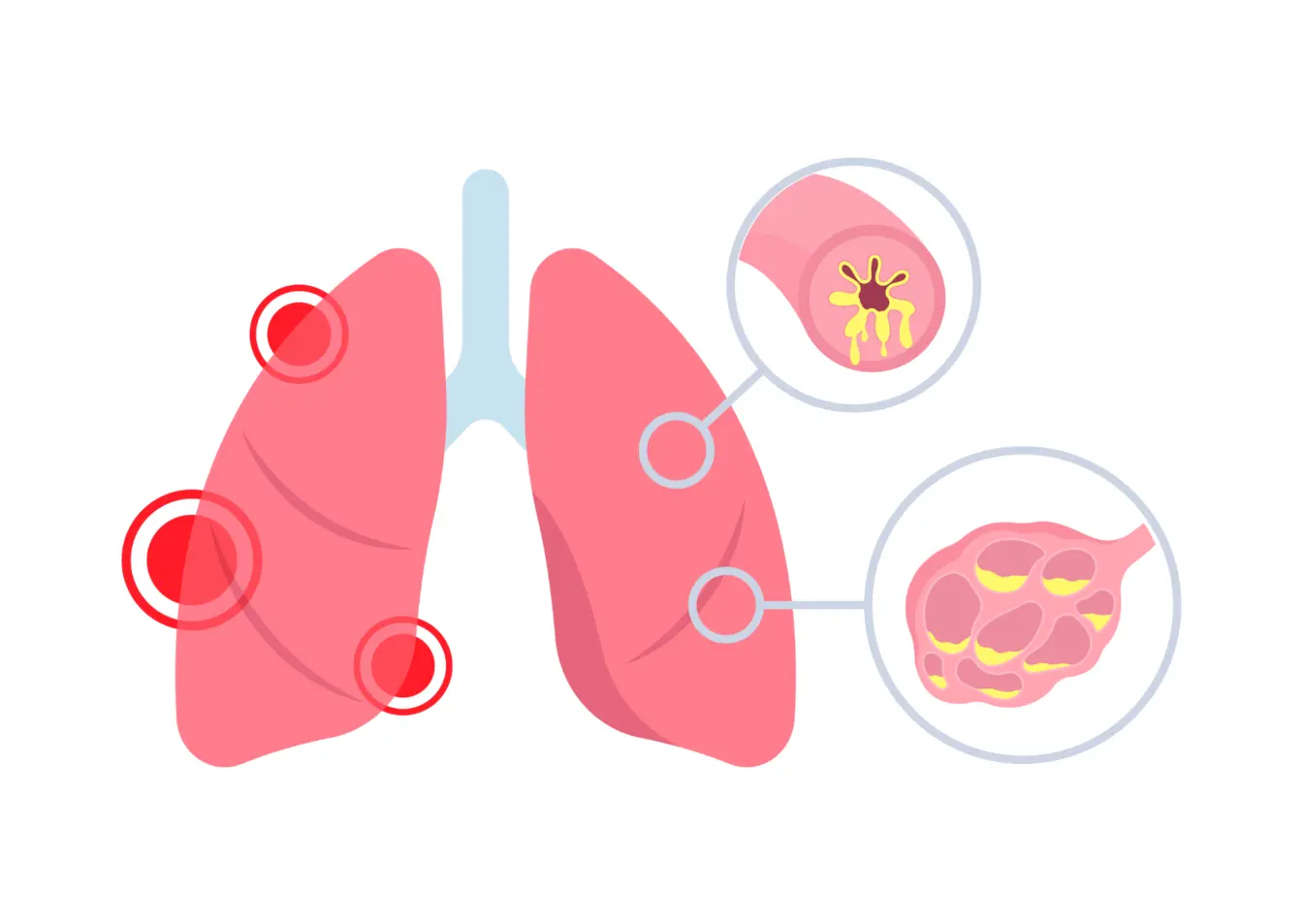 Grafik COPD
