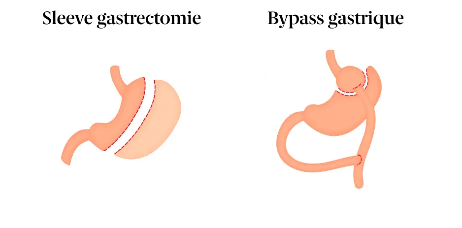 Traitement chirurgical